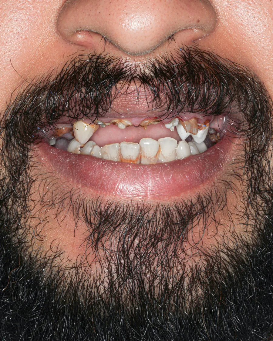 الحالة الأولى قبل العلاج